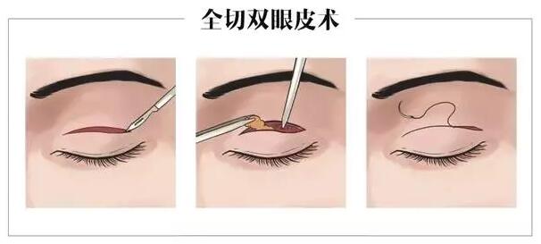 �������˽�˫��Ƥ�Ϳ��۽�