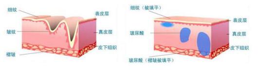 注射除皱是常用的除皱方法，效果很不错哦