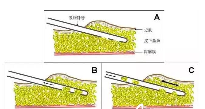 ����Easylipo����֬��  �ݾ�����ô��