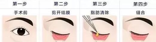 ȥ�۴���ȥ�ṵ�����õķ���