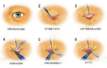 ȥ�۴���ȥ�ṵ�����õķ���