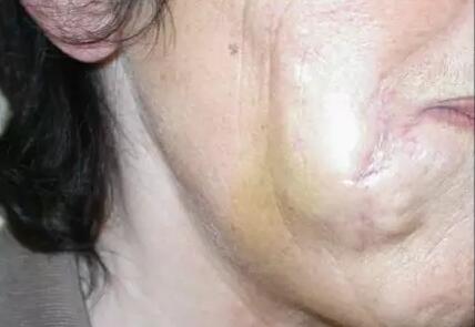 �̵�10�ֲ������������Ĳ���֢���䴦����ʽ