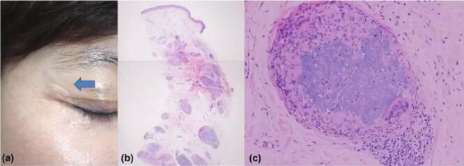 �̵�10�ֲ������������Ĳ���֢���䴦����ʽ