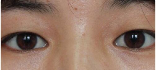 ���人һ������ҽԺ�����6mm΢������˫��Ƥ����5800