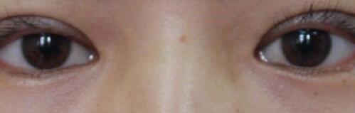 ���人һ������ҽԺ�����6mm΢������˫��Ƥ����5800