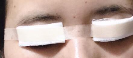 ���人һ������ҽԺ�����6mm΢������˫��Ƥ����5800