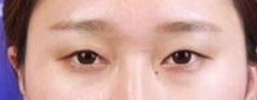 ������ҽ����������˫��Ƥ+�������۽�����4����