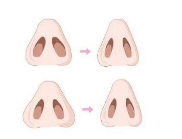 鼻孔太大想缩小可以用的四种方法