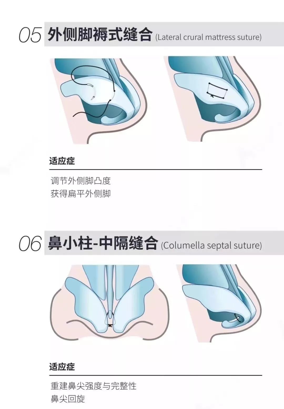 【图示讲解】13种鼻尖缝合技术