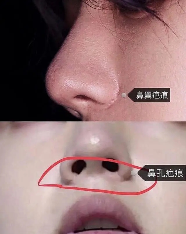 0鼻综合】怎么缩窄鼻翼不留痕迹    很多人鼻子不好看,鼻翼占了很重的