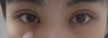 ˫��Ƥ����45�죬������а�Ĵ��۾�