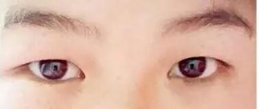 如何断定自己长眼袋?眼袋怎么去除效果好?