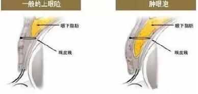 如何断定自己长眼袋?眼袋怎么去除效果好?