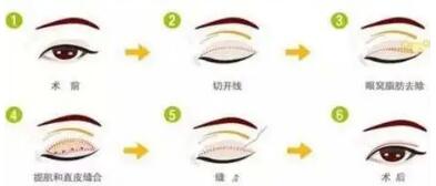 如何断定自己长眼袋?眼袋怎么去除效果好?