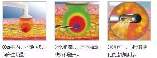 �ƽ�΢����ʲôЧ����������֬����ʲô����