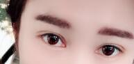 埋线双眼皮手术后,我的眼睛变得如此的漂亮
