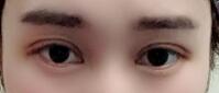 埋线双眼皮手术后,我的眼睛变得如此的漂亮