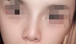 做了隆鼻手术,大致是花费了5个小时的时间