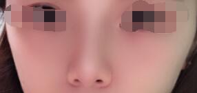 做了隆鼻手术,大致是花费了5个小时的时间