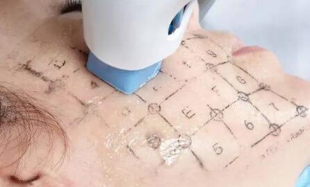 ȫ�ܿ�˥�����꼪��Thermage���������˥�ϵ����ͣ��