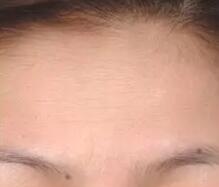 光子嫩肤术后15天,气质瞬间提升档次