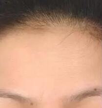 光子嫩肤术后15天,气质瞬间提升档次