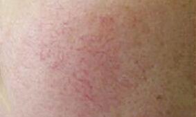 ����ȥ��Ѫ˿�������ĸ��º��Ѫ˿������������