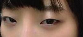 双眼皮手术后的第三天,期待着恢复后的样子