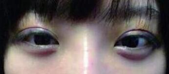 双眼皮手术后的第三天,期待着恢复后的样子