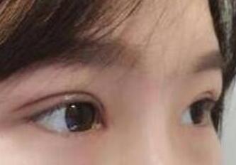 ˫��Ƥ����67�죬�۾���������Ҳ���ź���