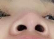 隆鼻后三个月左右,鼻子的轮廓形状很明显了