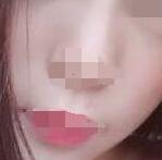 彩光嫩肤术后3个月,给整个人的肌肤改善很多