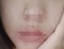 彩光嫩肤术后3个月,给整个人的肌肤改善很多