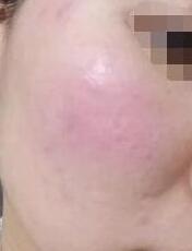 ����ȥ��Ѫ˿����������º�Ƥ��Խ��Խ��