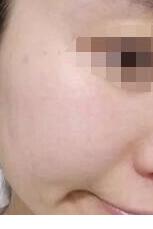 ����ȥ��Ѫ˿����������º�Ƥ��Խ��Խ��