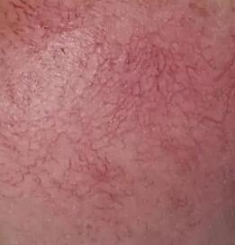 ����ȥ��Ѫ˿�����������20�����ʱ������ܶ�