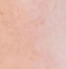 ����ȥ��Ѫ˿�����������20�����ʱ������ܶ�