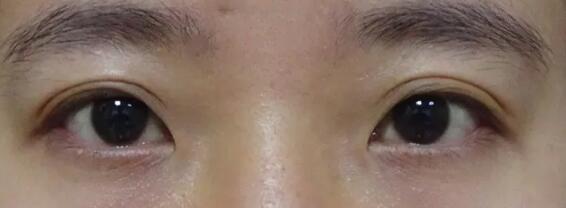 ��˫��Ƥ�����Ѿ������ʱ���ˣ�����ֱ��һ�㶼�����������ĺۼ�