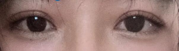 ��˫��Ƥ�����Ѿ������ʱ���ˣ�����ֱ��һ�㶼�����������ĺۼ�