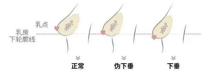胸部下垂的原因是什么呢?该如何改善