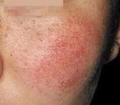 ����ȥ��Ѫ˿����������15����ֵ�����