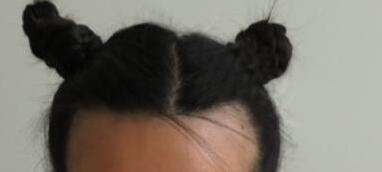 发际线种植让我随便换各式各样的发型了