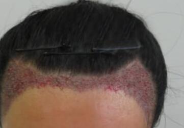 发际线种植让我随便换各式各样的发型了