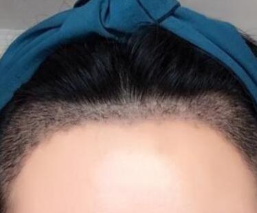 发际线种植让我随便换各式各样的发型了