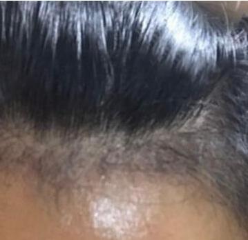 发际线种植让我随便换各式各样的发型了