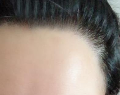 发际线种植让我随便换各式各样的发型了