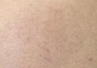 ����ȥ��Ѫ˿����һ���£�Ƥ������ǰ�úܶ�