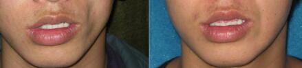 ����ҽ��˵���ڿ�����֬������޸��沿���ݵķ���ѡ��