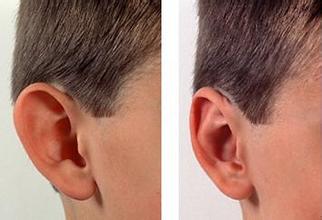 招风耳为常见的先天性耳廓畸形,招风耳朵是一种常见的耳部畸形问题